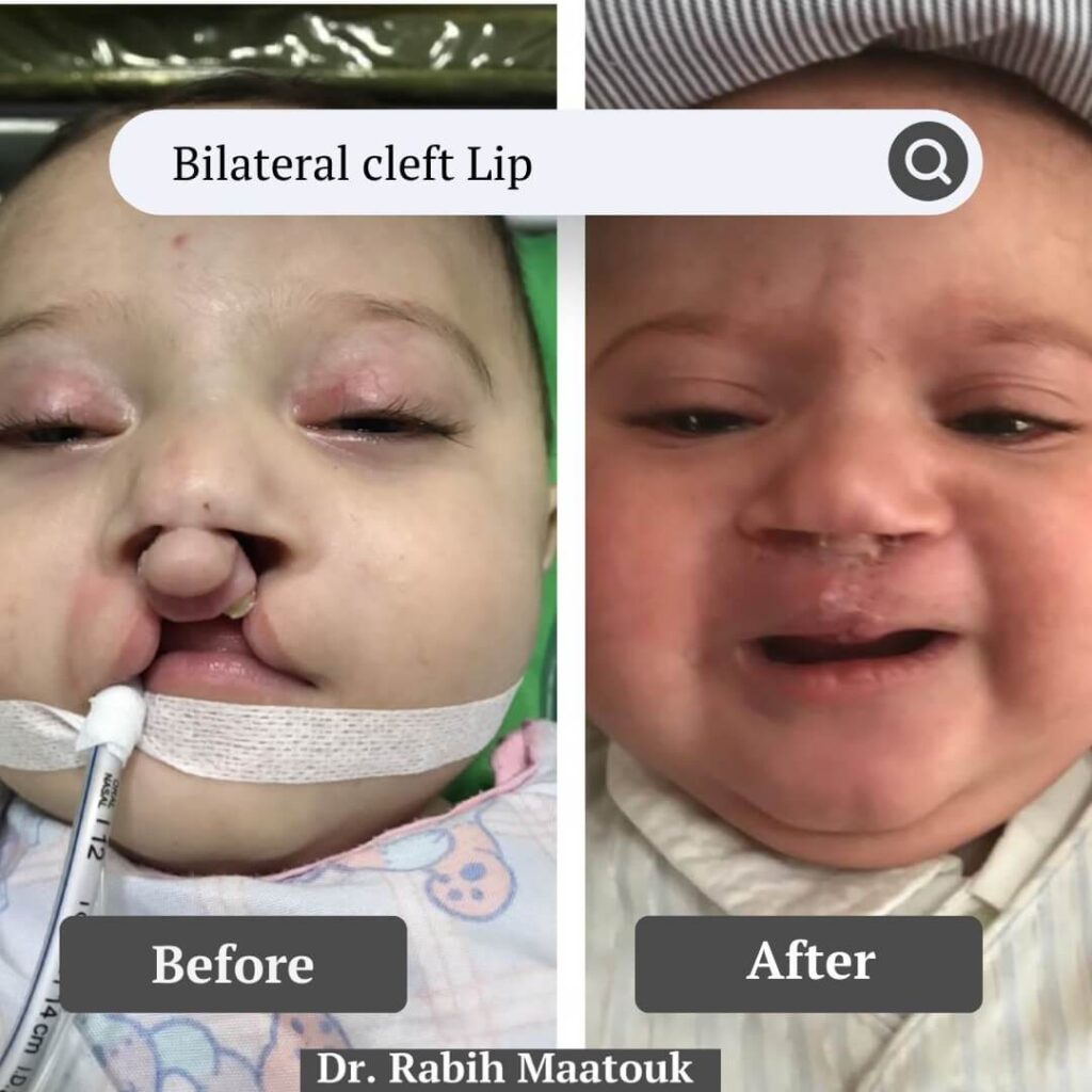 Bilateral Cleft Lip