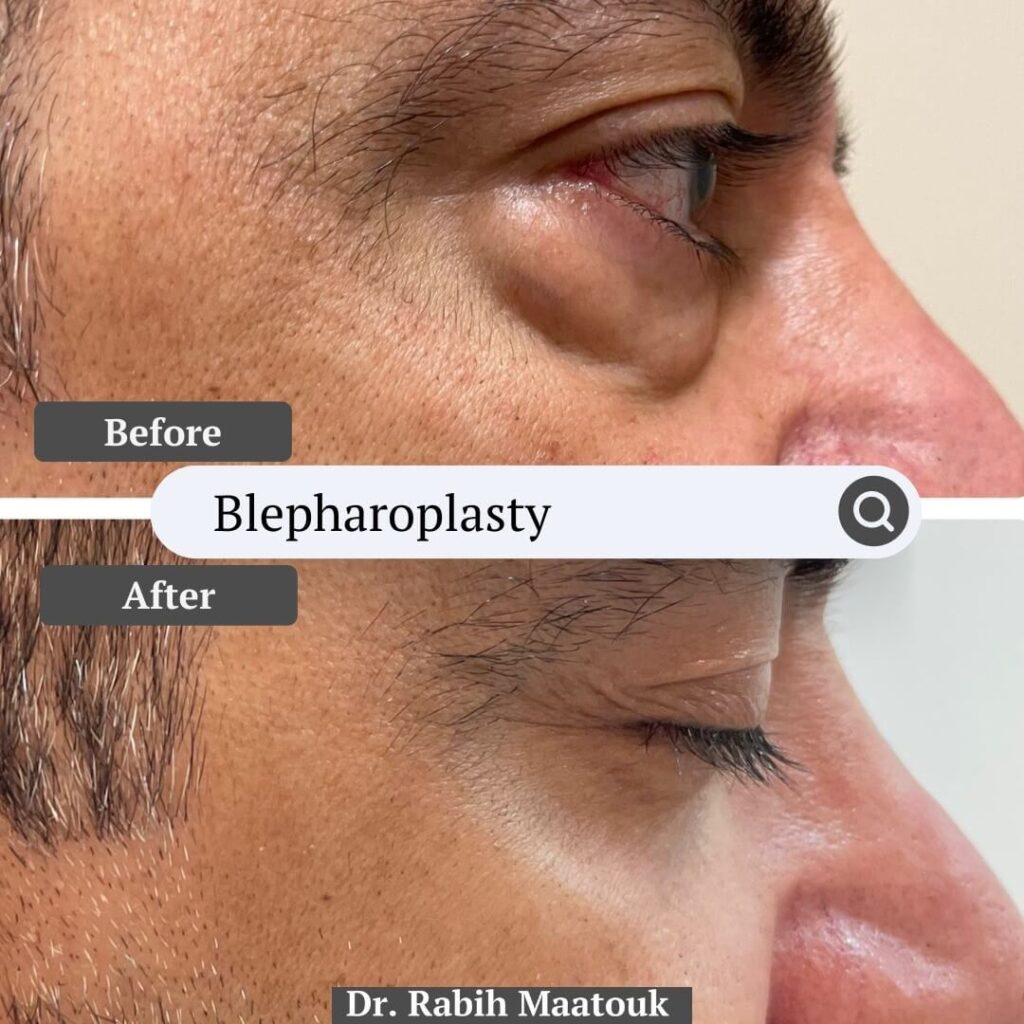 Blepharoplasty