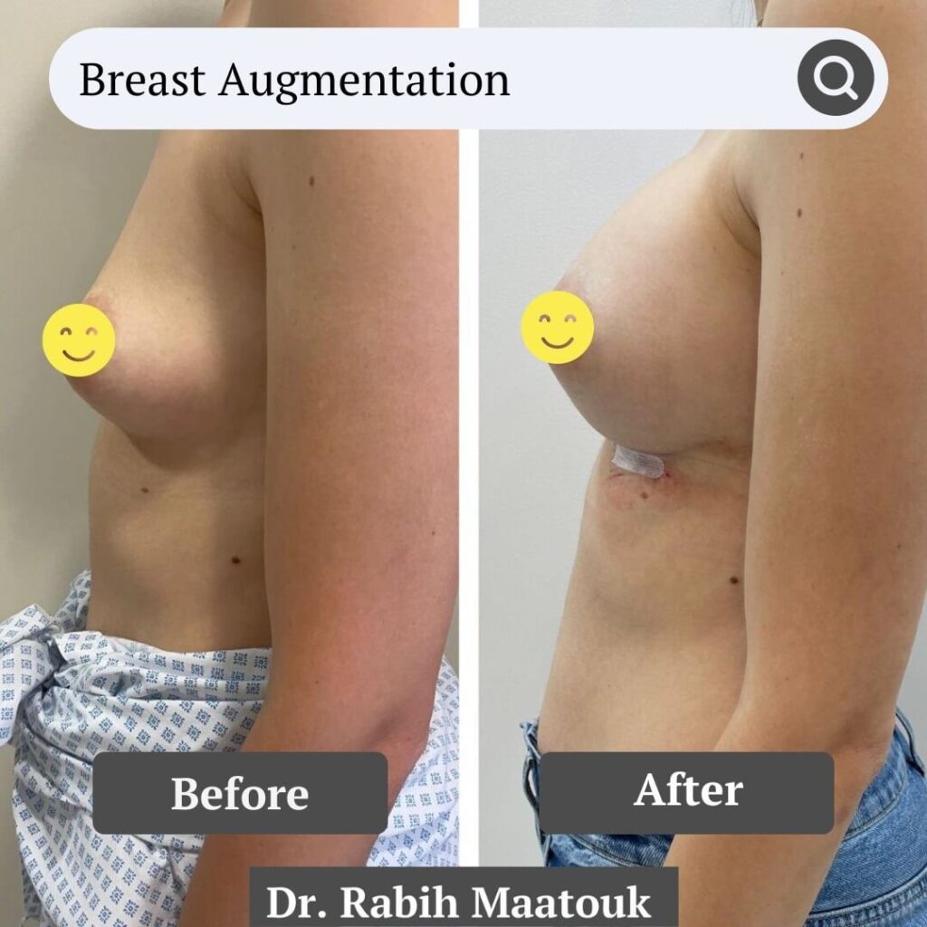 Breast Augmentation Before After by Dr. Rabih Maatouk (2)