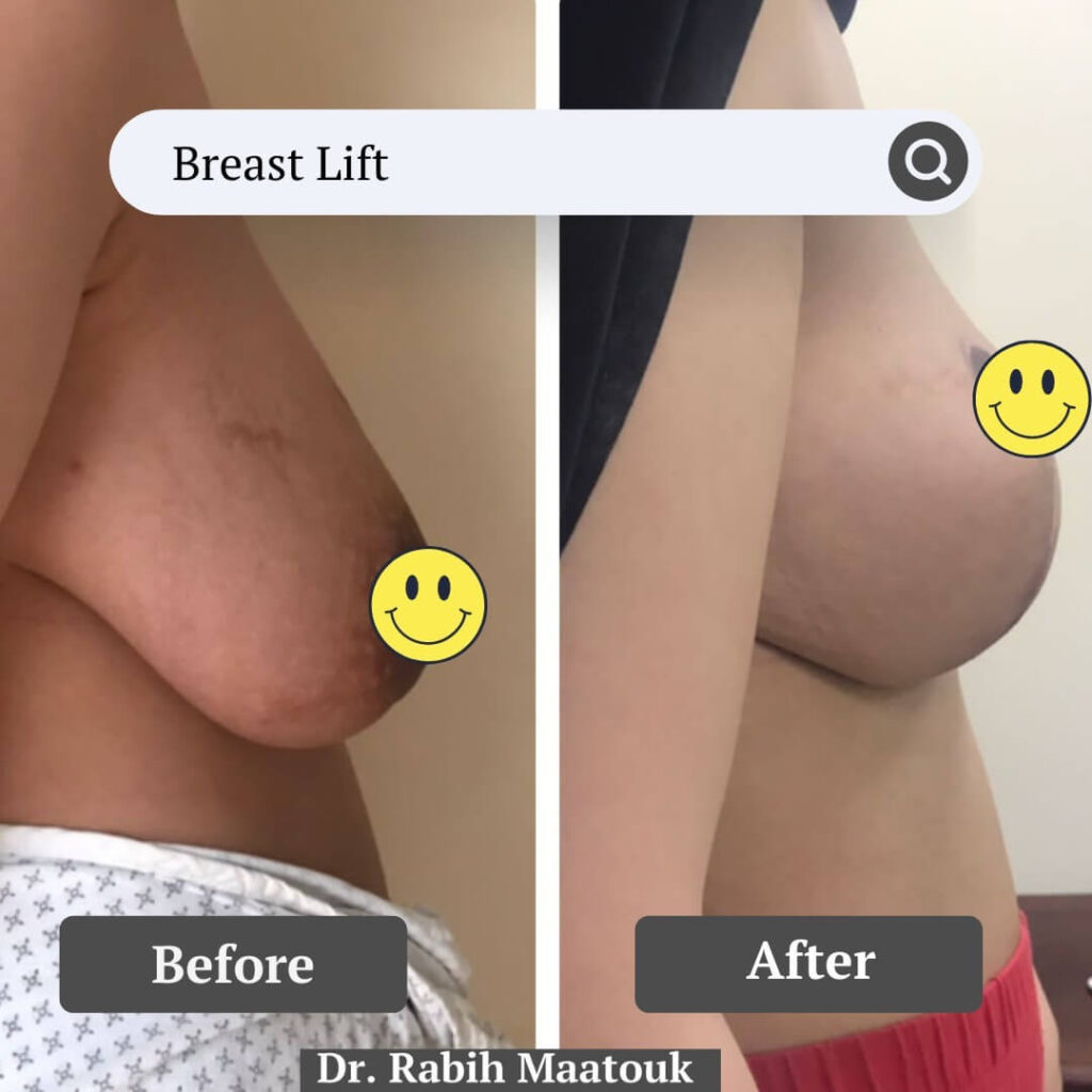 Breast Lift