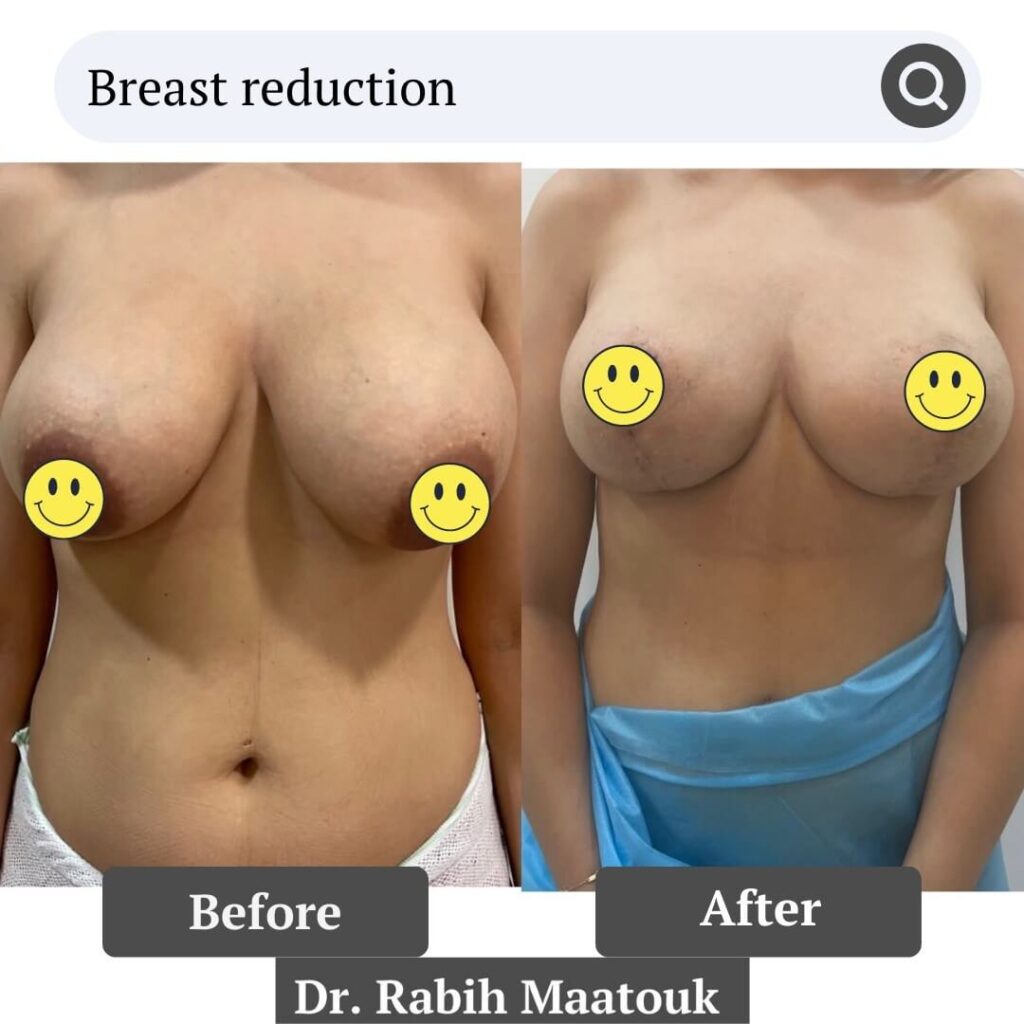 Breast Reduction Before After by Dr. Rabih Maatouk
