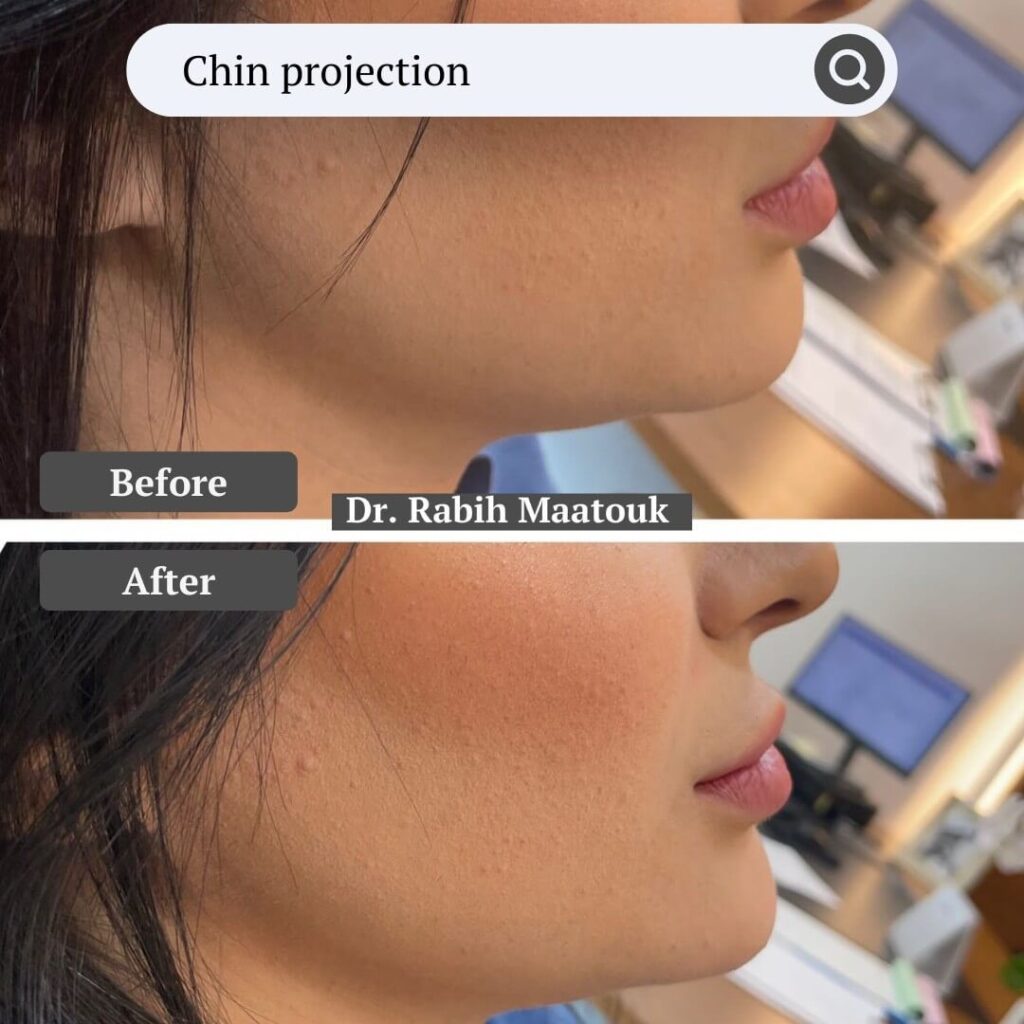 Chin Projection