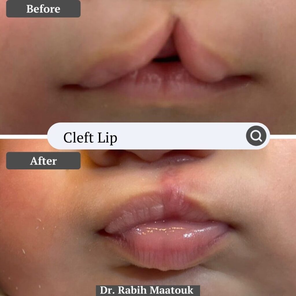 Cleft Lift Before After by Dr. Rabih Maatouk