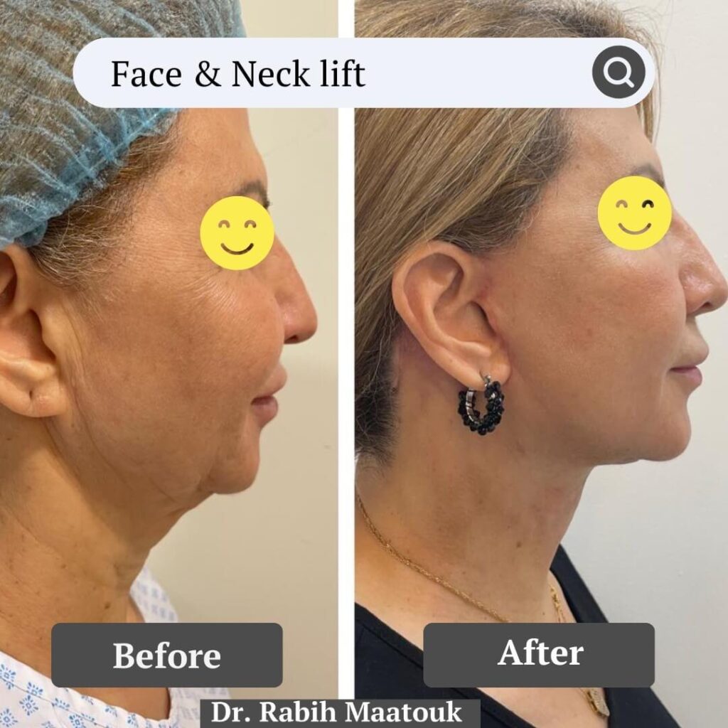 Face & Neck Lift Before After by Dr. Rabih Maatouk