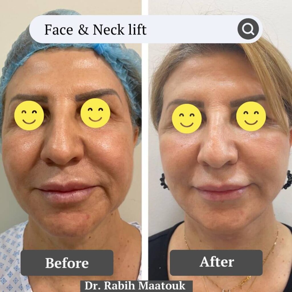 Face & Neck Lift Before After by Dr. Rabih Maatouk