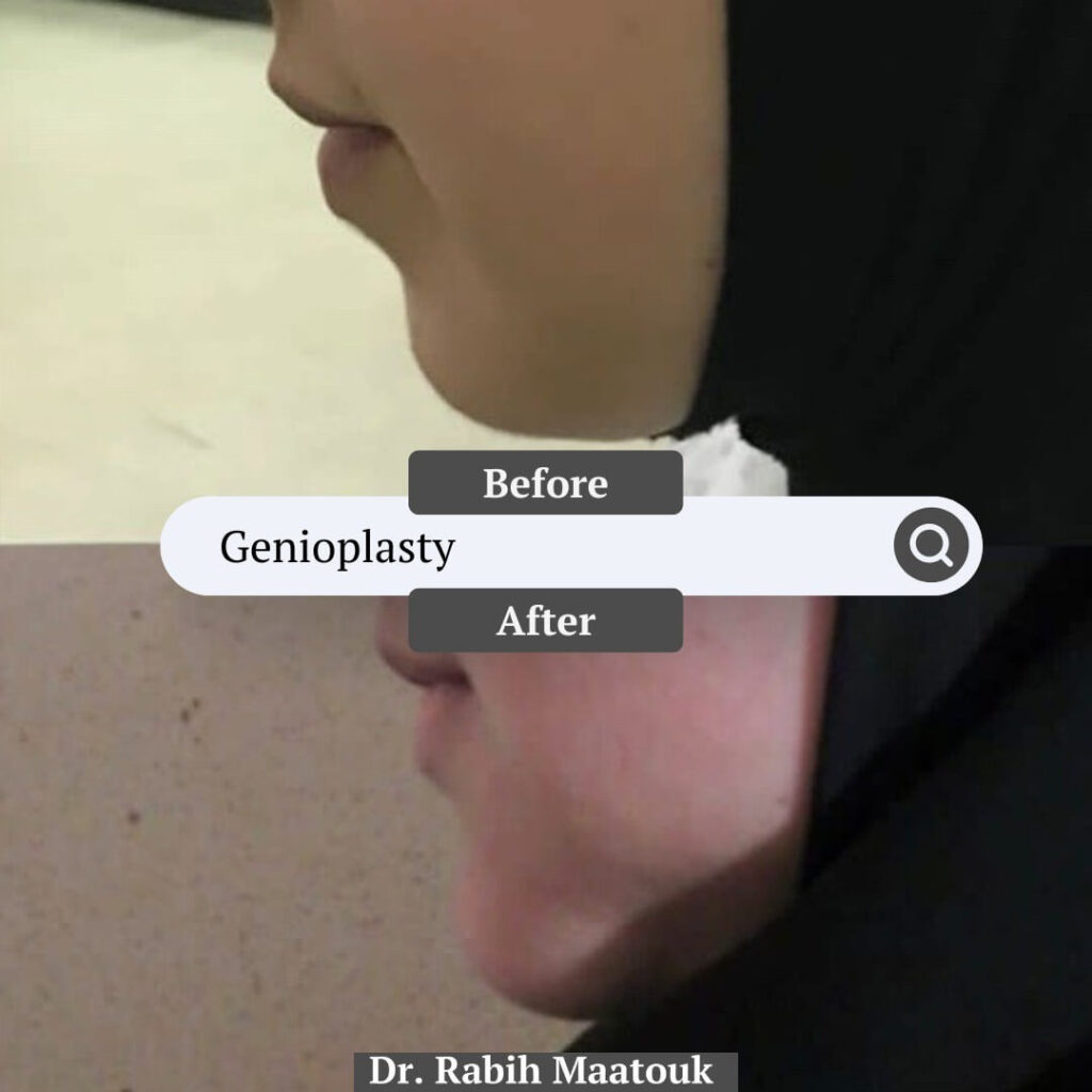 Genioplasty Surgery