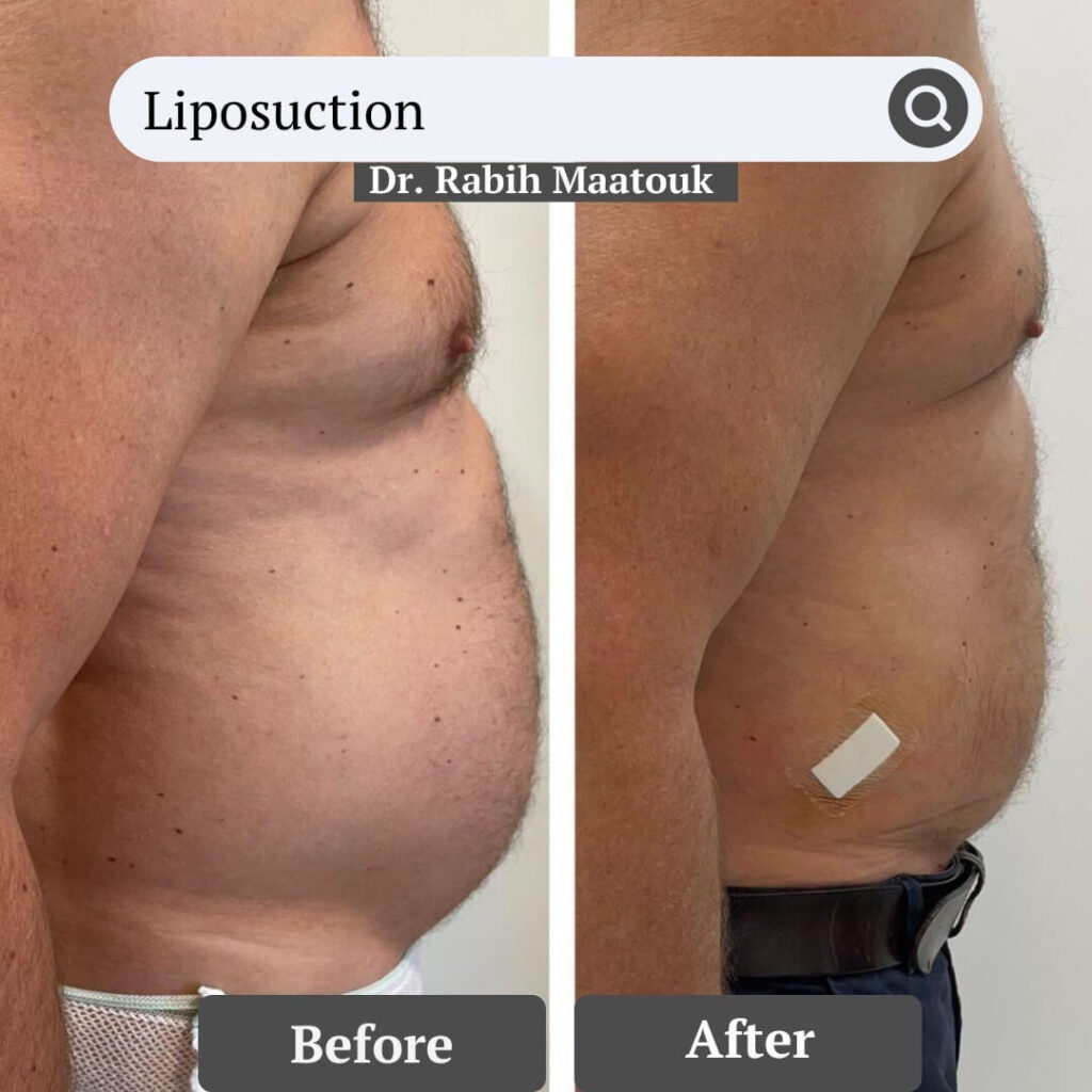 Liposuction