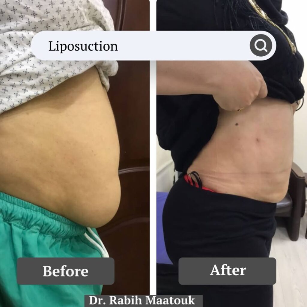Liposuction Body Contouring Abu Dhabi