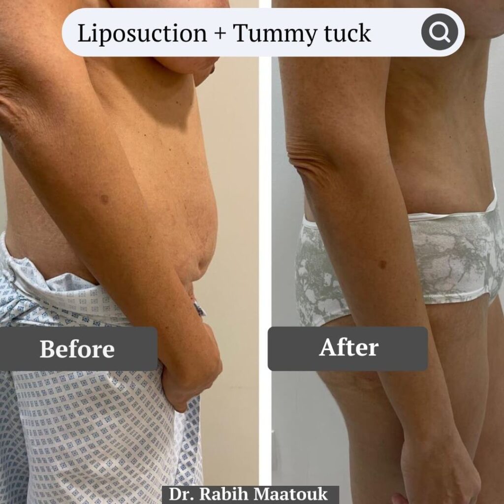 Liposuction & Tummy Tuck Before After by Dr. Rabih Maatouk