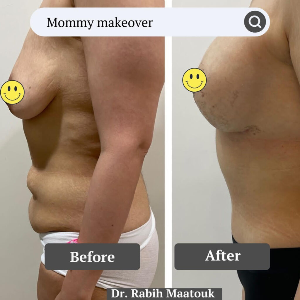 Mommy Makeover