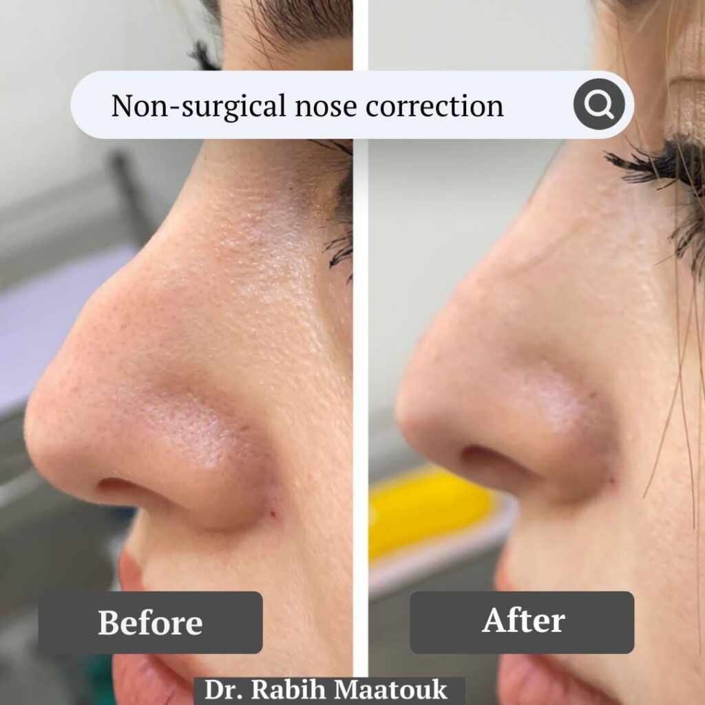 Non Surgical Nose job