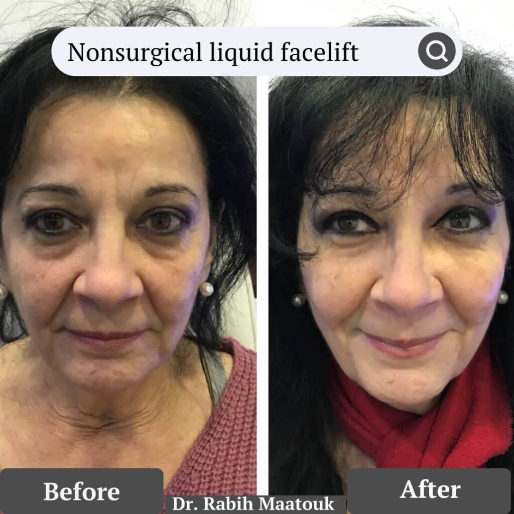 Non surgical liquid Face Lift Before After by Dr. Rabih Maatouk