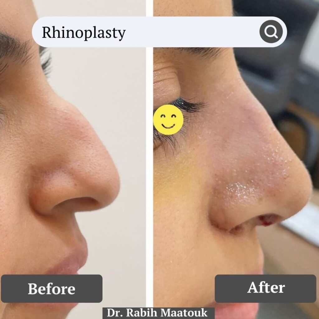 Nose Correction