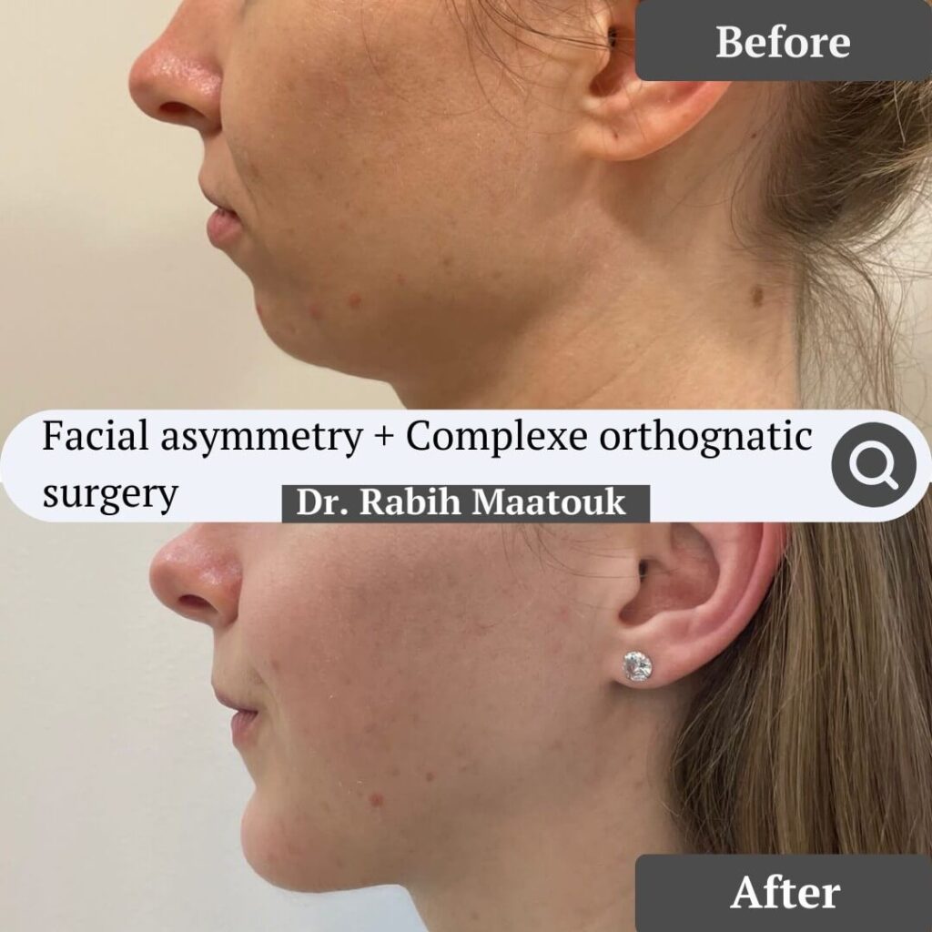 Orthognathic Surgery