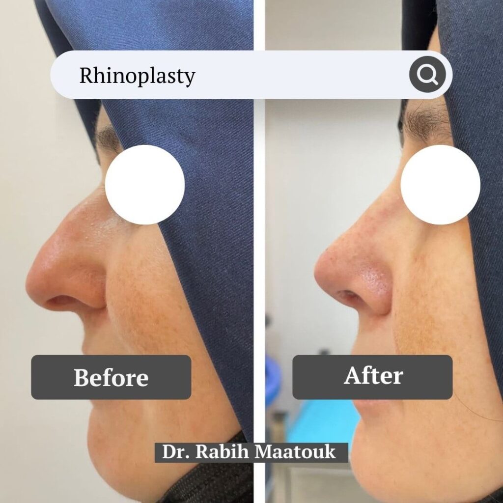 Rhinoplasty Before After by Dr. Rabih Maatouk