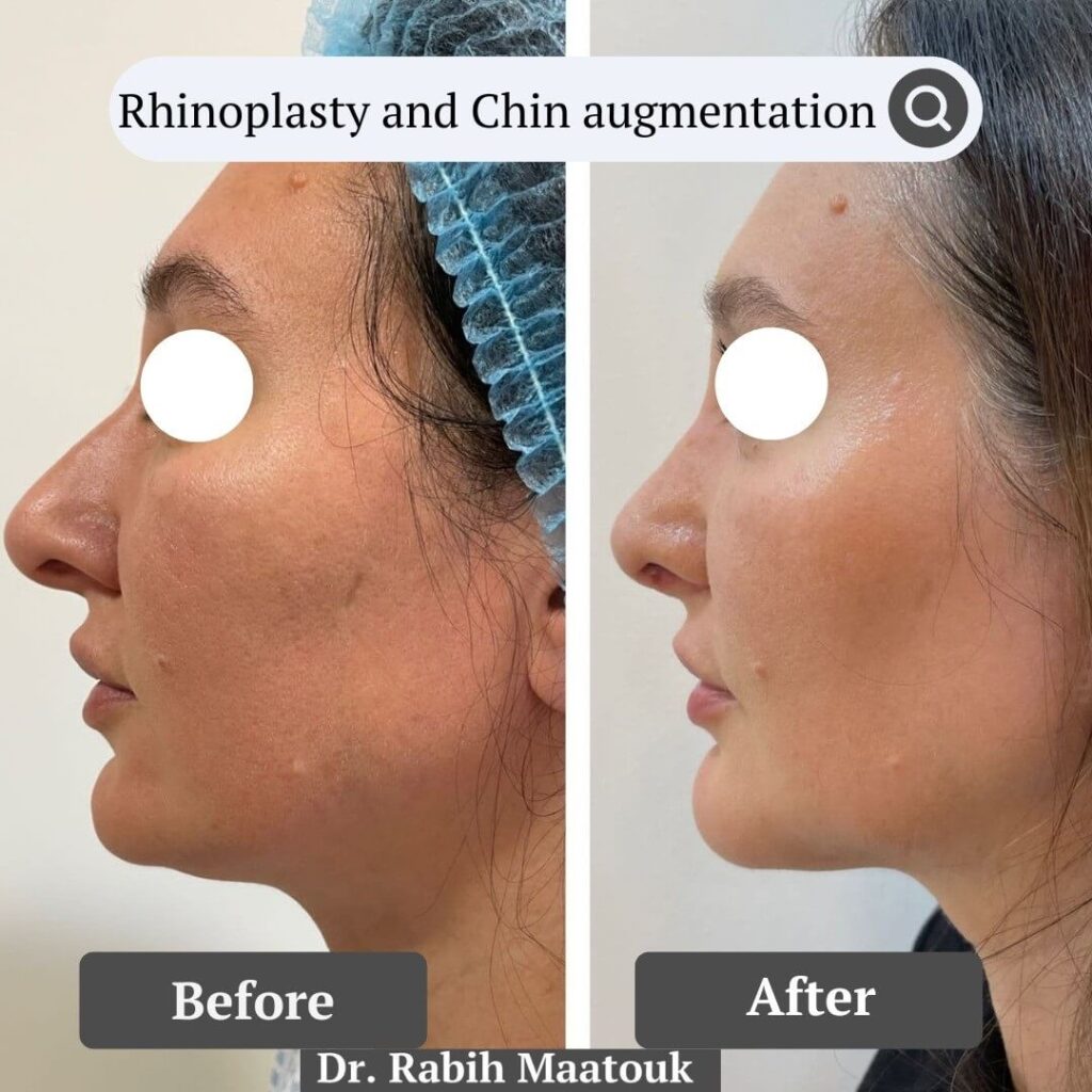 Rhinoplasty & Chin Augmentation by Dr. Rabih Maatouk