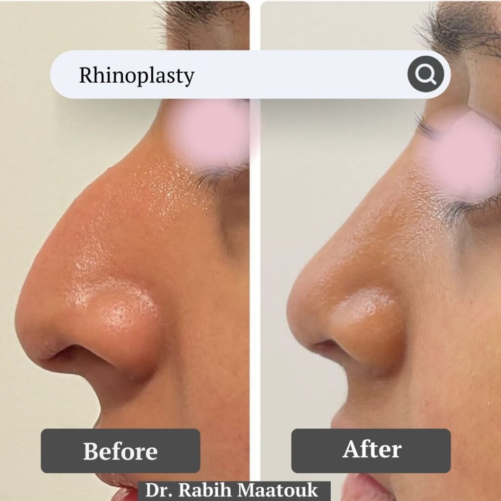 Rhinoplasty