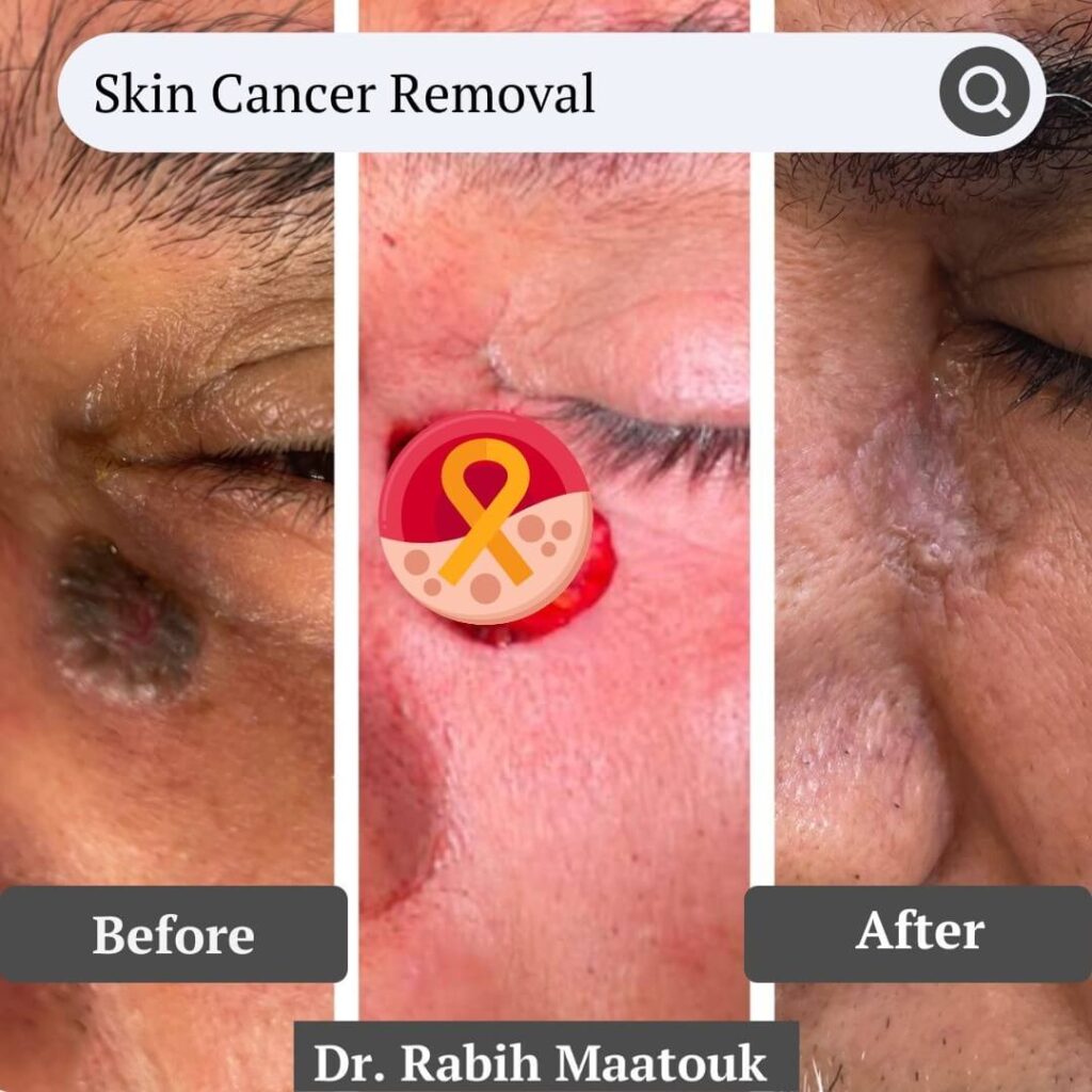 Skin Cancer Removal