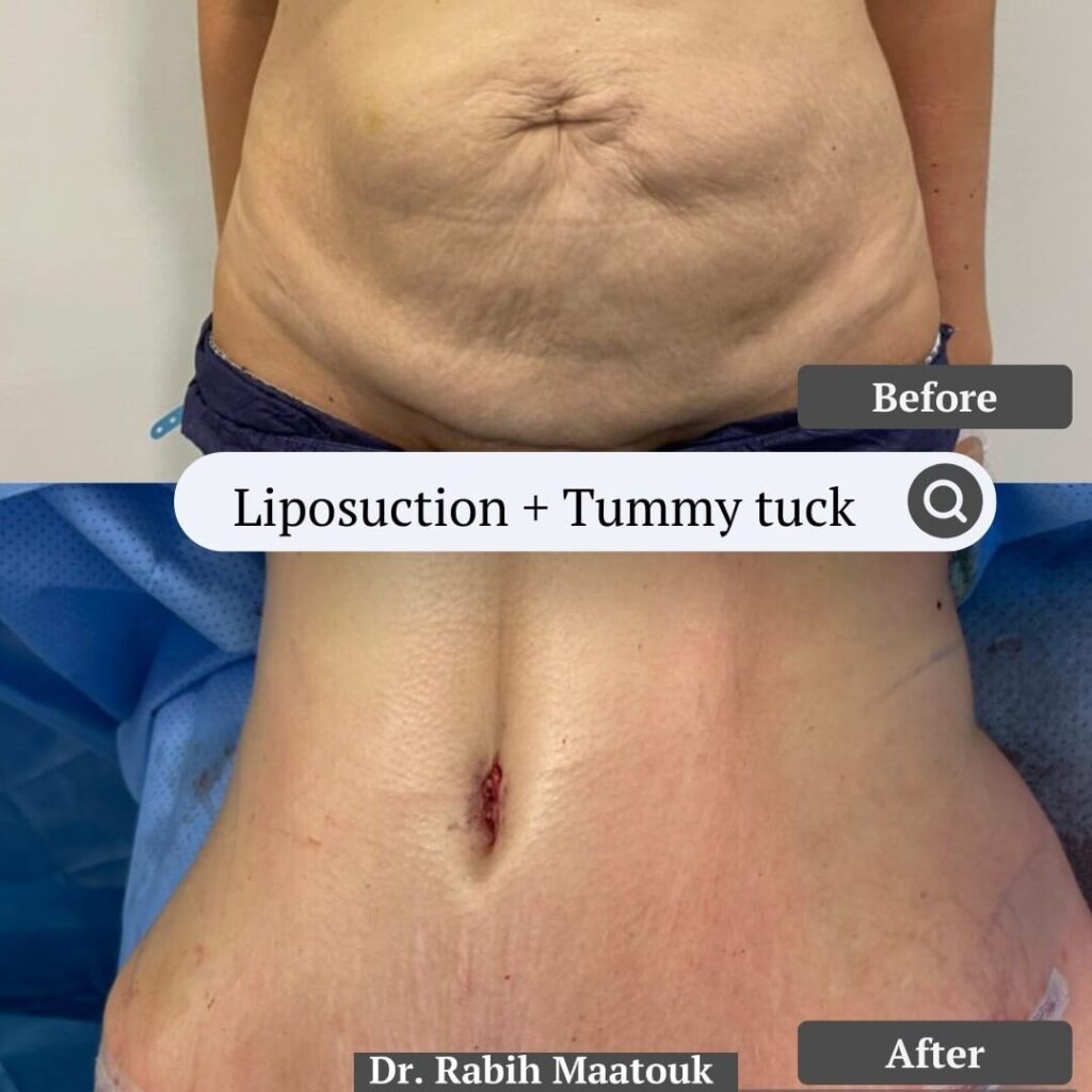 Tummy Tuck