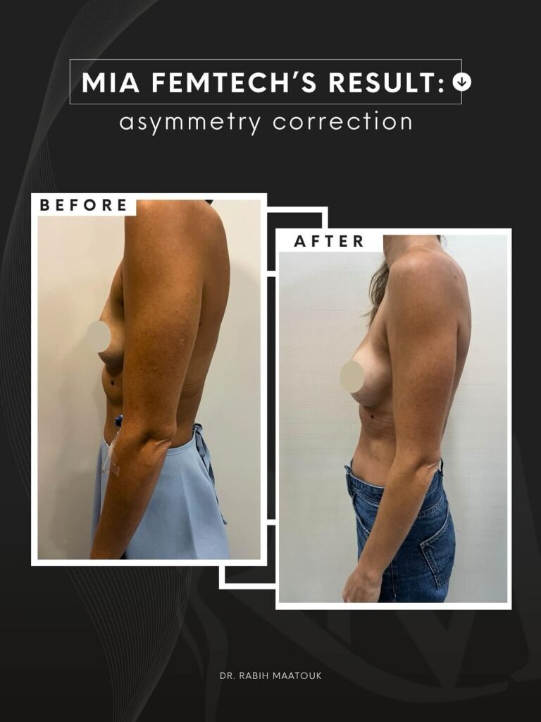 Mia Breast Augmentation Dr. Rabih Abu Dhabi 3