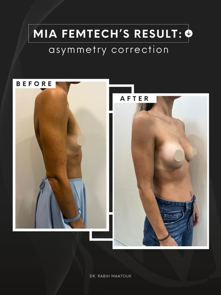 Mia Breast Augmentation by Dr. Maatouk